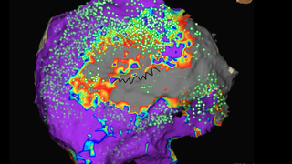 Cardiac ablation for AFib: The latest techniques to keep your heart in rhythm