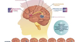 Countering aphasia with targeted speech-language rehab