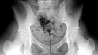 Young and hip: Joint preservation surgery may be the long-term answer to hip pain