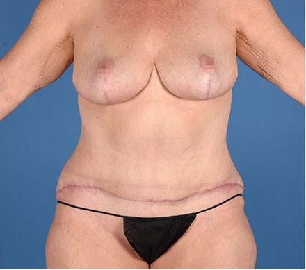 Post photo of a woman getting body contouring and breast procedures