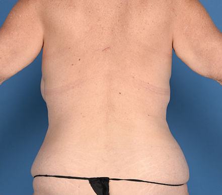 Pre photo of a woman getting body contouring and breast procedures