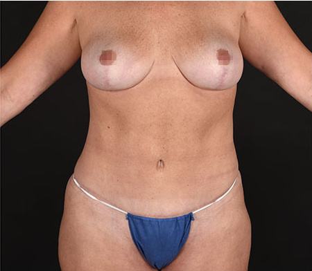 Post photo of a woman getting breast and body procedures