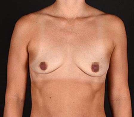 Pre photo of woman getting a breast procedure