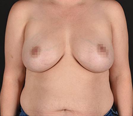 Post photo of woman getting a breast procedure