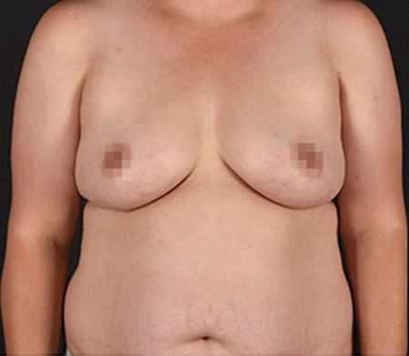 Pre photo of woman getting a breast procedure