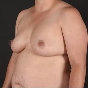 Pre photo of woman getting a breast procedure