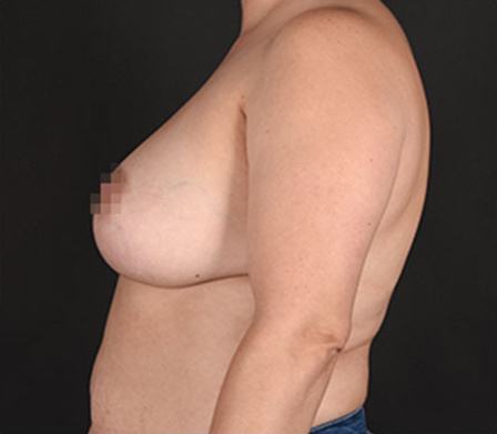 Post photo of woman getting a breast procedure