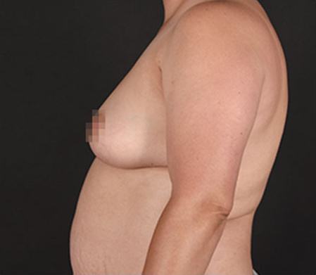 Pre photo of woman getting a breast procedure