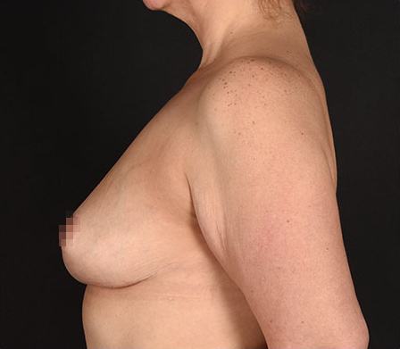Post photo of woman getting a breast procedure