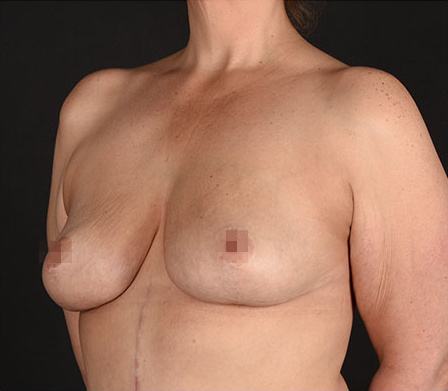 Post photo of woman getting a breast procedure
