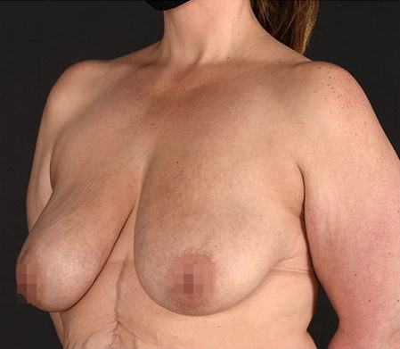 Pre photo of woman getting a breast procedure