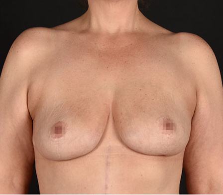 Post photo of woman getting a breast procedure