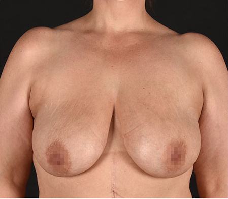 Pre photo of woman getting a breast procedure