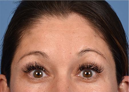Post photo of woman getting botox