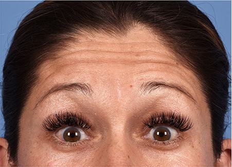 Pre photo of woman getting botox