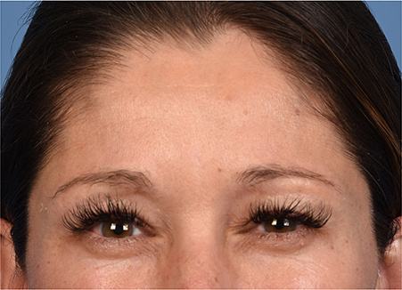 Post photo of woman getting botox