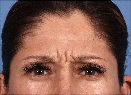 Pre photo of woman getting botox