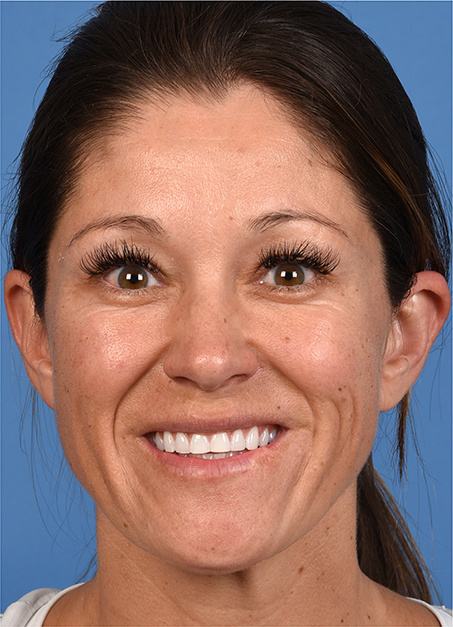 Post photo of woman getting botox
