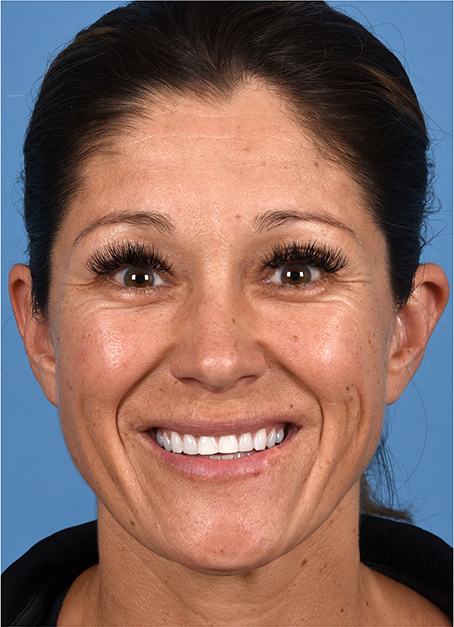 Pre photo of woman getting botox