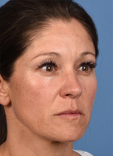 Post photo of woman getting botox