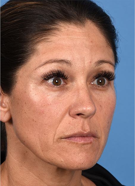 Pre photo of woman getting botox
