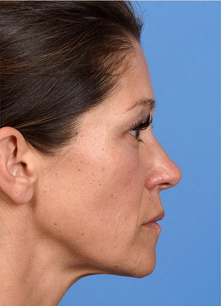 Post photo of woman getting botox