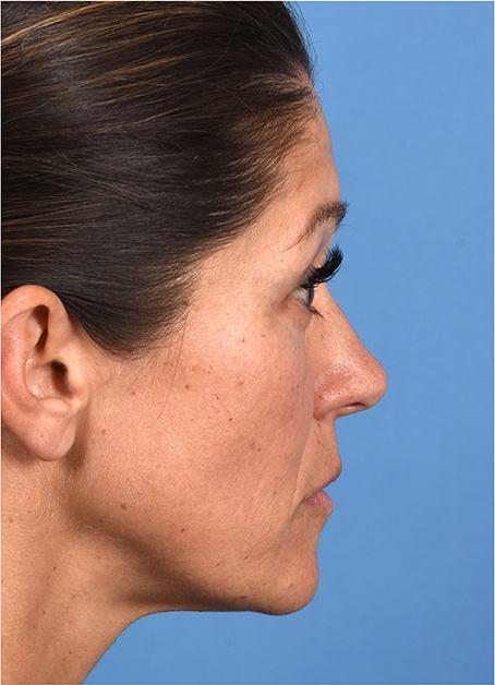 Pre photo of woman getting botox