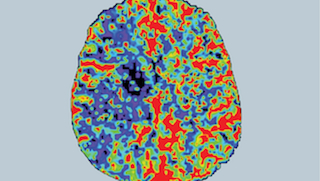 Breaking news: New stroke procedure quadruples care timeline