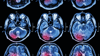 Q&A: Advances in Brain Tumor Treatment