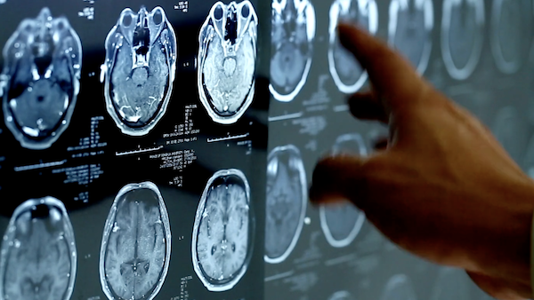 A story of Hope and teamwork: Facing a brain tumor at age 24