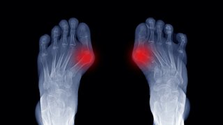3D bunion surgery gets you back on your feet faster