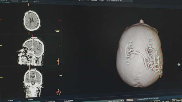 Exploring deep brain stimulation to manage treatment-resistant depression