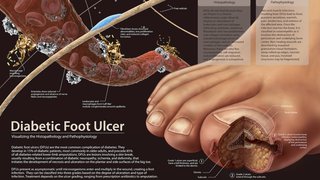 Diabetic foot ulcers: Surgery options to treat and prevent podiatric emergencies