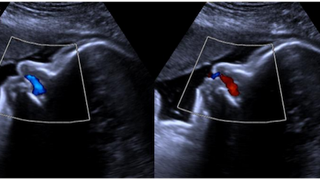 6 pregnancy ultrasound exams you might not need