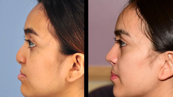 Cleft lip revision, rhinoplasty can restore confidence for teens and adults