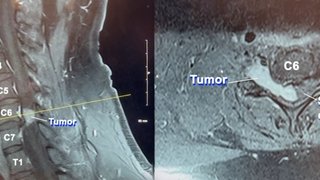 'Every day is a blessing': 11-hour surgery removes dangerous, rare spinal tumor