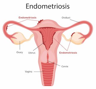 Breaking the silence about endometriosis | Women's Health | Your ...