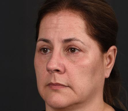 Post photo of woman getting an eye lift procedure