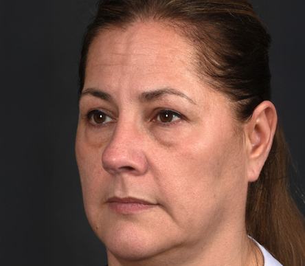 Pre photo of woman getting an eye lift procedure