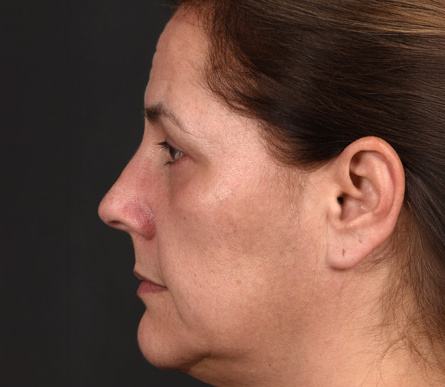 Post photo of woman getting an eye lift procedure