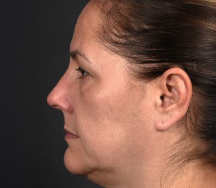 Pre photo of woman getting an eye lift procedure