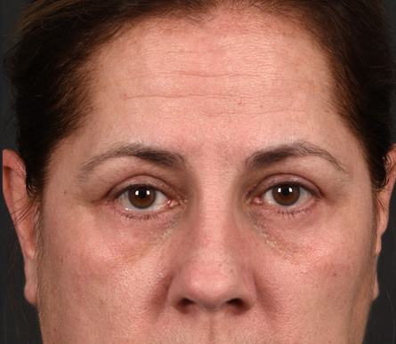Post photo of woman getting an eye lift procedure