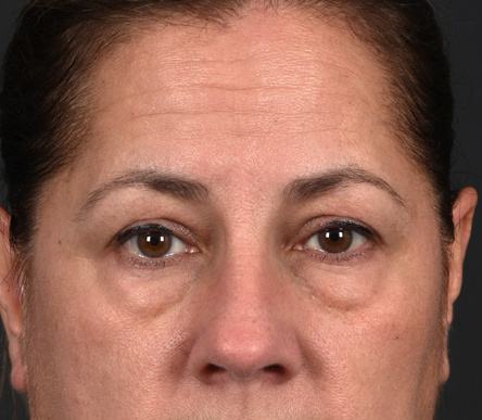 Pre photo of woman getting an eye lift procedure