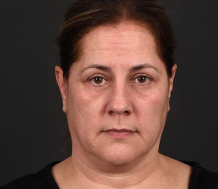 Post photo of woman getting an eye lift procedure