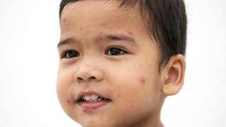 Measles and pregnancy: Navigating the risks during an outbreak