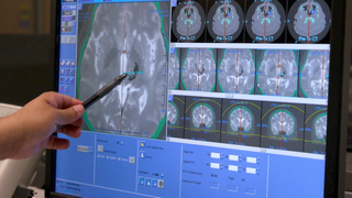 'It's like they flipped a switch': How HIFU relieved man's tremor after 50 years