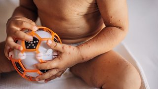 Parents’ guide to hand, foot, and mouth disease