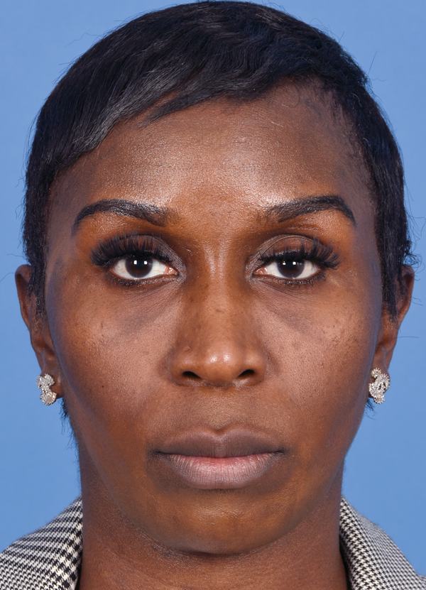 Post photo of woman getting botox