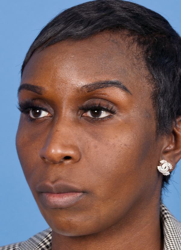 Post photo of woman getting botox