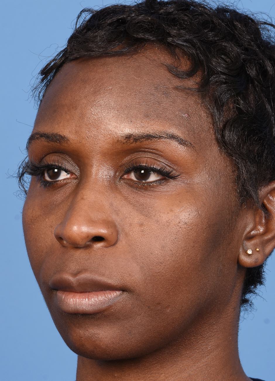 Pre photo of woman getting botox